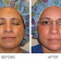Cosmelan Depigmentation Treatment & Advantages