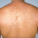 Discoloration of skin Causes