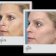 Hyperpigmentation Treatment