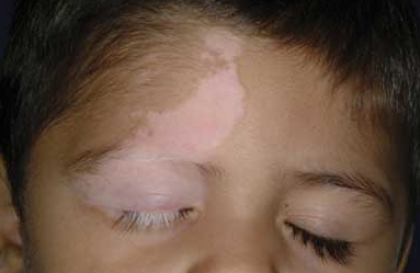 Symptoms-of-Vitiligo
