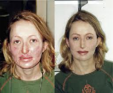 Vitiligo Cover Up Makeup