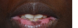 Vitiligo On Lips