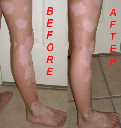 Vitiligo Protopic Results