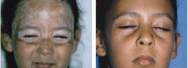 Vitiligo Repigmentation