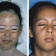 Vitiligo Repigmentation