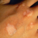 Vitiligo Symptoms