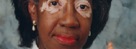 Vitiligo