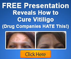 vitiligo1